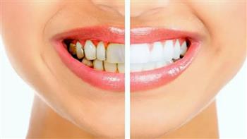 هذه العوامل تسبب أصفرار الأسنان