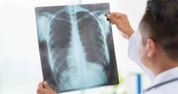 انتبه.. لأعراض التهاب الرئة الفيروسي