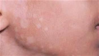  النخالة البيضاء وعلاجها البسيط