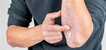 نصائح لتجنب الالتهابات الفطرية