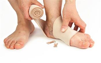 4  طرق للوقاية من دوالي الساقين