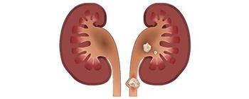 أعراض مبكرة تنذر بحصوات الكلى