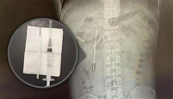 صيني يعيش بمقياس حرارة داخل أمعائه لمدة 20 عامًا