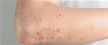 لمقاومة‭ ‬حساسية‭ ‬الجلد‭ ‬عليك‭ ‬بتجنب‭ ‬المسببات