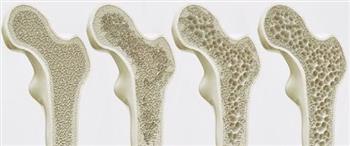 انتبه عوامل قد تؤدي لهشاشة العظام