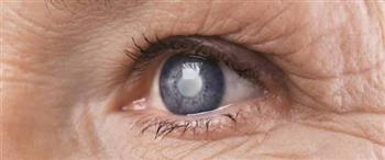 المياه البيضاء الأسباب والأعراض