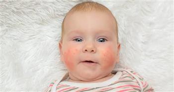 طرق التعامل مع "إكزيما الرضع" 