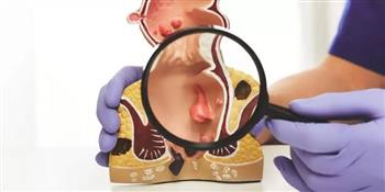 روشتة للوقاية من الخراج الشرجي