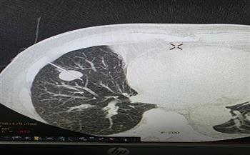 المستشفيات الجامعية بقنا تحقق إنجازًا طبيًا دقيقًا بنجاح سحب عينة من ورم بالرئة تحت توجيه الأشعة المقطعية