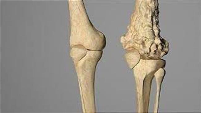 تعرف على الأعراض المبكرة لسرطان العظام