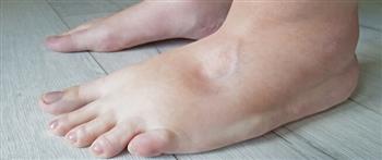 احتباس السوائل في الجسم..تعرف علي أعراضها