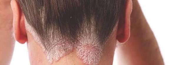 الضغوط‭ ‬النفسية‭ ‬المتهم‭ ‬الأول‭ ‬فى‭ ‬مرض‭ ‬صدفية‭ ‬الرأس