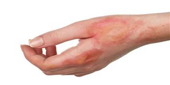 أسباب طفح التوتر الجلدي