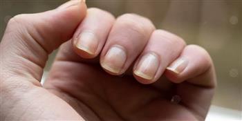 أسباب تحول الأظافر إلى اللون الأصفر