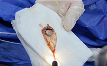 صحة الشرقية: استخراج بطارية من معدة طفلة ٤ سنوات بمنظار عاجل بمستشفى أبو كبير المركزي