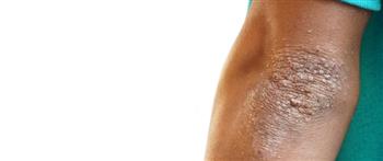 أسباب الشواك الأسود