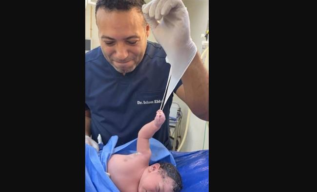 صورة مدهشة.. رضيع حديث الولادة يرفض ترك "قفاز الطبيب"
