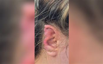 بسبب تأخرها في الحمام.. رجل برازيلي يقضم أذن زوجته