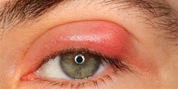 3  طرق للتعامل مع التهاب الجفون