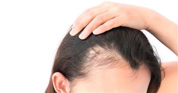 الفرق بين الصلع الوراثي وتساقط الشعر