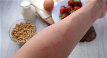 علامات حساسية الطعام