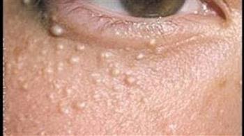 ماذا تعرف عن حبوب الميليا..الأسباب والعلاجات البسيطة