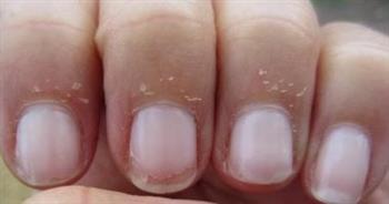 تلك هي أسباب جفاف الجلد المحيط بالأظافر