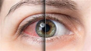 أسباب جفاف العين