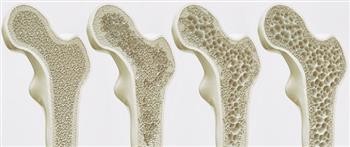 نصائح للوقاية من هشاشة العظام