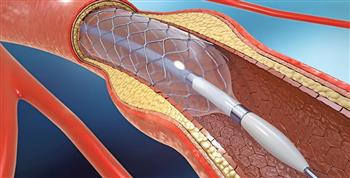 نصائح  بعد إجراء القسطرة القلبية