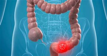 أعراض الزوائد اللحمية بالقولون ومضاعفاتها