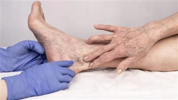 4  نصائح للوقاية من دوالي الساقين