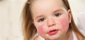 أعراض ظهور حساسية الوجه في الربيع