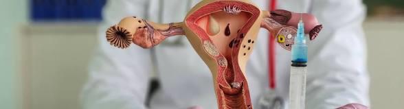 أعراض تكيس المبايض