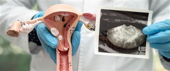 انتبه..  تكيس المبايض وراء زيادة الوزن