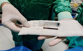 استخرج مسـمار معدني بطول 10 سم من الاثني عشر لطفلة عمرها عامان دون جرا حة بمستشفيات جامعة الزقازيق