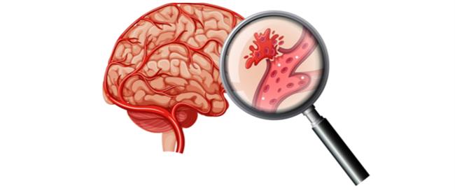 علامات جلطة المخ الخفيفة