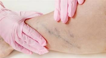 علامات وأعراض جلطات الساق ومضاعفاتها