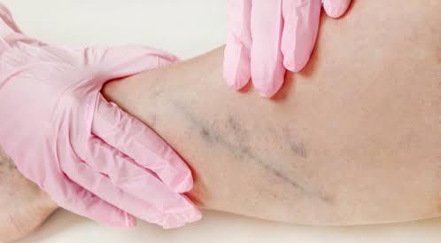 علامات وأعراض جلطات الساق ومضاعفاتها