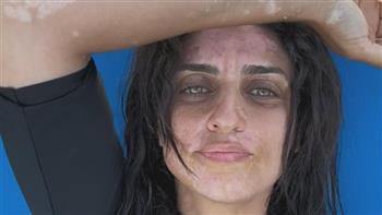 نسرين كرارة توضح حقيقة إصابتها بالبهاق وتعلق على تصدرها التريند