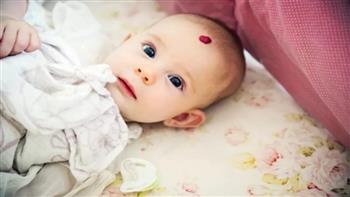 ماذا تعرف عن وحمة الفراولة؟ 