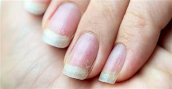 أهم أسباب تشقق الأظافر