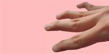 أسباب تقوس الأصابع