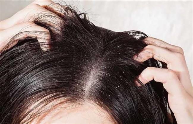 للتخلص من قشرة الشعر.. وصفات طبيعية تساعد على تهدئة فروة الرأس