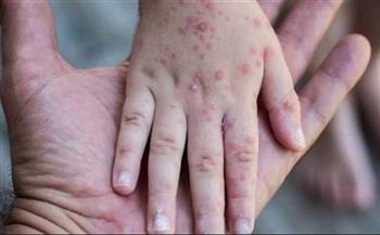 الأمم المتحدة تحذر من انتشار واسع وسريع لمرض "جدري الماء" في غزة