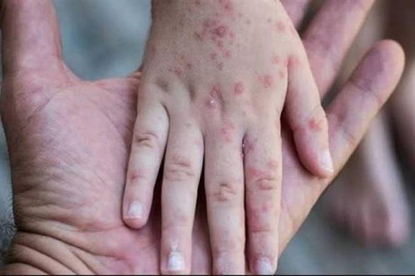 الأمم المتحدة تحذر من انتشار واسع وسريع لمرض "جدري الماء" في غزة