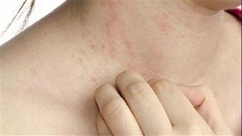 ما العلاقة بين مقاومة الأنسولين وتكيس المبايض؟