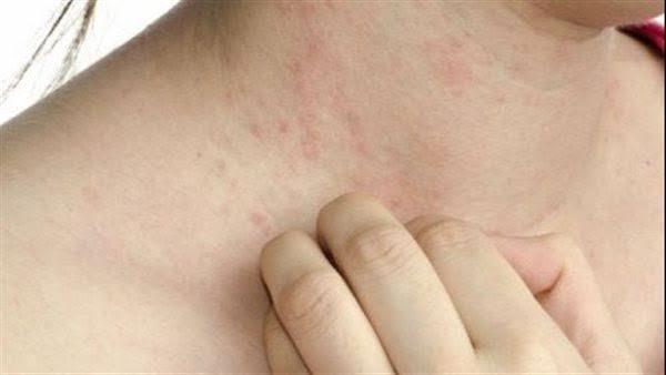 ما العلاقة بين مقاومة الأنسولين وتكيس المبايض؟