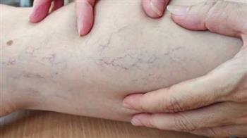 أسباب زيادة متاعب دوالي الساقين في الصيف