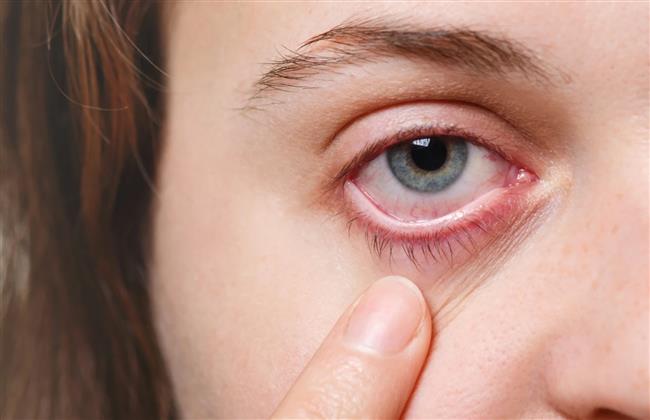 أعراض وأسباب جفاف العين